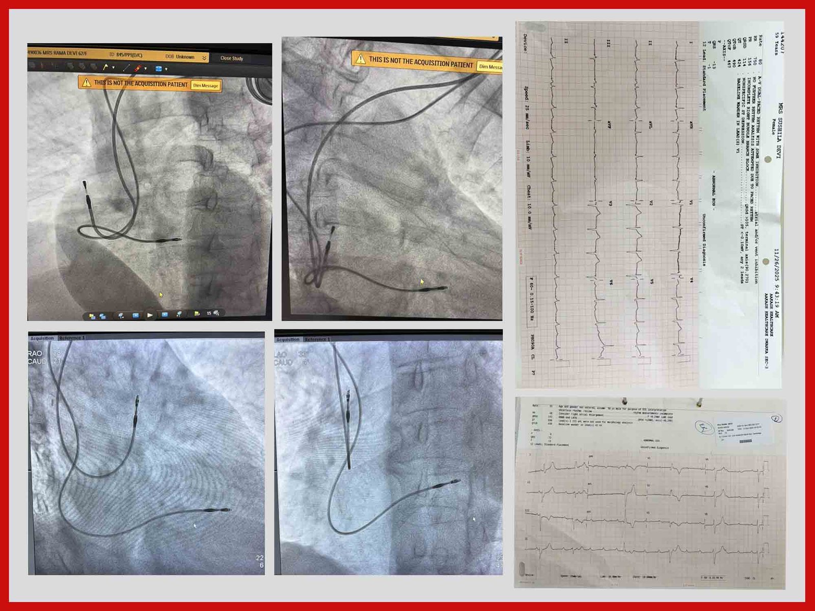 conduction-system-pacing-procedure